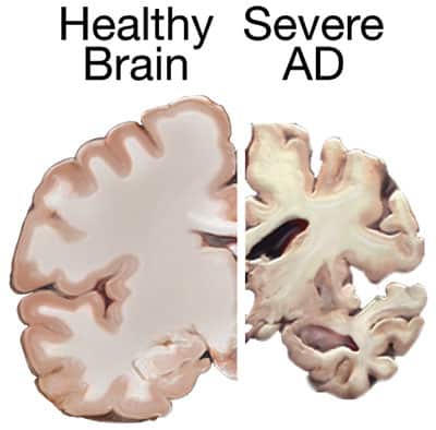 Alzheimer's Brain Healthy Brain